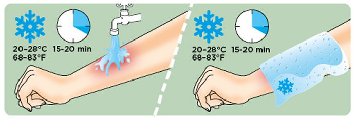 Illustrasjon av nedkjøling av brannskade med vann og vått omslag