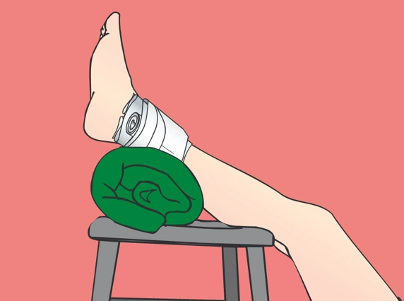 Illustrasjon av ett ben som hviler på en krakk med en bandasje rundt ankel